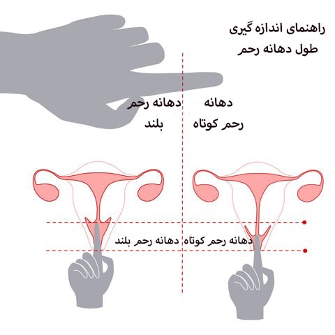 اندازه گیری طول دهانه رحم