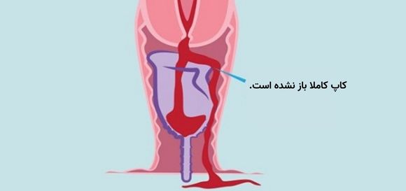 باز نشدن کاپ قاعدگی